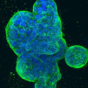 breast-cancer-cells-article